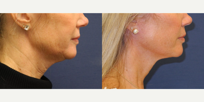 Woman in her mid 50s treated with Facelift as well as Facial Fat Transfer and Liposuction - Woman in her mid 50s treated with Faceliftwith ext pmp andTisseel as well as Facial Fat Transfer, and Liposuction to neckarea, shown 7 months post op.