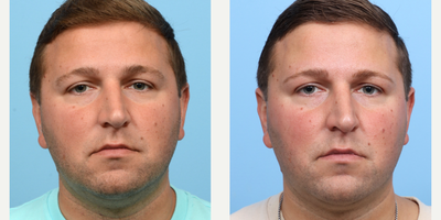 25-34 year old man treated with CoolMini, CoolSculpting, Ultherapy - In order to contour the lower face and eliminate his double chin, this patient underwent two CoolMini sessions and a single lower face Ultherapy treatment. Three months following the initial treatment, the patient observed significant improvement in the targeted areas.