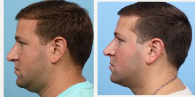25-34 year old man treated with CoolMini, CoolSculpting, Ultherapy - In order to contour the lower face and eliminate his double chin, this patient underwent two CoolMini sessions and a single lower face Ultherapy treatment. Three months following the initial treatment, the patient observed significant improvement in the targeted areas.