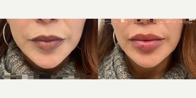 Woman treated with Lip Fillers - Woman treated with Lip Fillers
