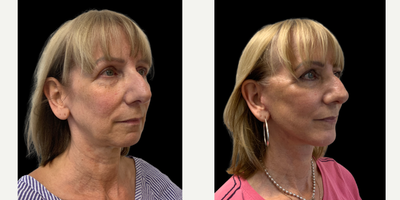 55-64 year old woman treated with Facelift, Chin Implant, SMAS Facelift, Neck Lift, Lower Facelift - Patient who has undergone a deep plane facelift, chin implant and necklift