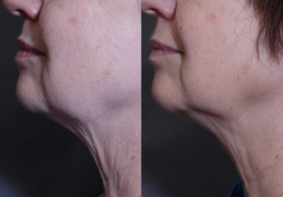45-54 year old woman treated with Laser Treatment - Laser Titan Treatment: Neck