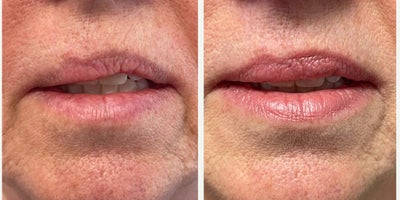 55-64 year old woman treated with Lip Surgery - 57 year old female underwent Upper Lip Reconstruction surgery under local anesthesia.