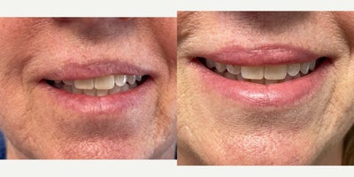 55-64 year old woman treated with Lip Surgery - 57 year old female underwent Upper Lip Reconstruction surgery under local anesthesia.