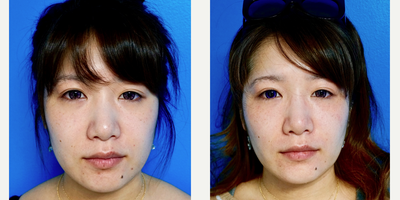 25-34 year old woman treated with Buccal Fat Removal - Buccal Fat Removal