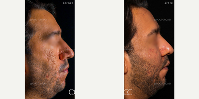 35-44 year old man treated with a combination acne scar treatment. - We successfully treated this patient's acne scars with a combination acne scar treatment with subcision, bellafill and CO2 Laser.