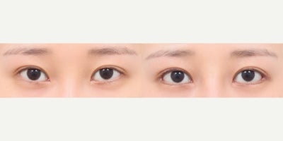 25-34 year old woman treated with Canthoplasty - She had lower lateral canthoplasty, lateral canthoplasty