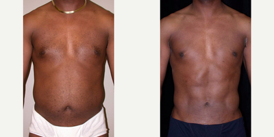 35-44 year old male treated with SAFELipo - This patient received a male breast reduction coupled with SAFEliposuction in ourpractice.