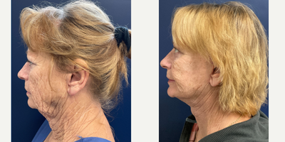 65-74 year old woman treated with Facelift, Facial Fat Transfer - Here is another great before and after by Dr. Leveque.Facelift with fat transfer, age-71, 6 weeks post-op.