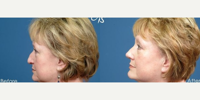 Woman treated with Rhinoplasty - This patient underwent septoplasty, dorsal reduction with osteotomy with tip rhinoplasty. 