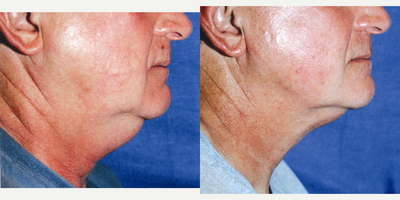 45-54 year old man treated with Titan - no liposuction was done here--just a single Titan treatment. Titan can tighten skin and create new elastin and collagen fibers, holding tissue in like spandex