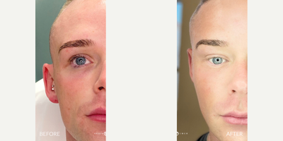 25-34 year old man treated with PlasmaPen - Laser combination to resurface skin and soften old, deep acne scars