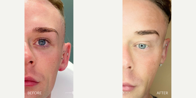 25-34 year old man treated with PlasmaPen - Laser combination to resurface skin and soften old, deep acne scars