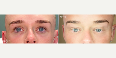 25-34 year old man treated with PlasmaPen - Laser combination to resurface skin and soften old, deep acne scars