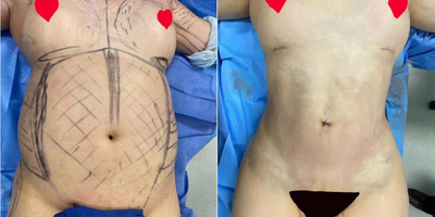 Brazilian Butt Lift - This is a male-to-female transgender in her early 40s. She wanted a more feminine body: more curves on her hips, bigger buttocks, and a subtle increase in the size of her breasts without increasing her breast implant size. Today, I performed liposuction of the abdomen, superior iliac crest (or love handles), lower back, and arms. I collected the good fat and transferred the good fat to her hips, buttocks, and breasts. I performed a bilateral breast capsulotomy and replaced her intact silicone breast implants through an inframammary incision.