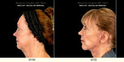 55-64 year old woman treated with Neck Lift, Buccal Fat Removal - NECK LIFT - BUCCAL FAT REMOVAL