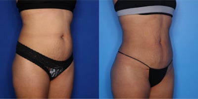 35-44 year old woman treated with BodyTite, Liposuction - 41 year old female with 2 kids shown 3 months after BodyTite lipo 360 to her abdomen and flanks with 2 L removed.