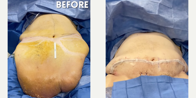 Man treated with Panniculectomy - Witness the incredible transformation journey of a patient who underwent a life-changing Panniculectomy procedure, having over 70 lbs of excess skin and fat removed by Dr. Katzen.This patient faced the challenge of an extreme pannus, with excess skin and fat hanging below the waistline. After seeking help from multiple doctors, he found his solution by traveling from Las Vegas to Dr. Katzens office in Beverly Hills.