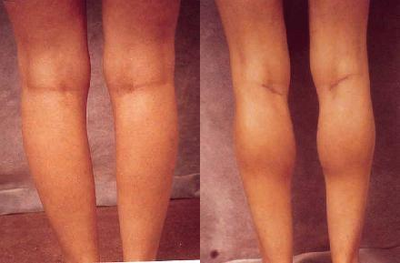 Women's Calf Augmentation - 
	Women&#39;s Calf Augmentation W/Implants
