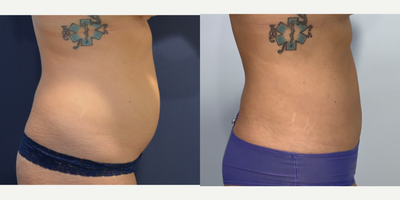 25-34 year old woman treated with Liposuction - This is an active young woman who exhausted her ability to achieve her goals through diet & exercise. She finally tried liposuction of her abdomen & flanks.