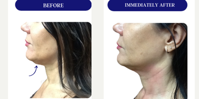 45-54 year old woman treated with Fractora RF, Forma, Facial, Skin Tightening, Skin Rejuvenation - FRACTORA FIRM-FORMAbipolar radiofrequency
