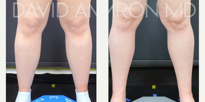 Woman treated with Lipedema Surgery - Woman treated with Lipedema Surgery