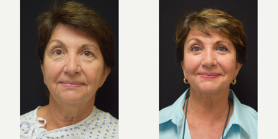 65-74 year old woman treated with Deep Plane Facelift, CO2 Laser, fat transfer, and lower bleph - 65-74 year old woman treated with Deep Plane Facelift, CO2 Laser, fat transfer, and lower blepharoplasty