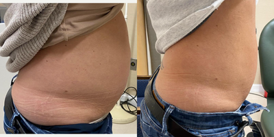 55-64 year old woman treated with truSculpt iD - Before and after 1 treatment of Trusculpt iD on the abdomen.