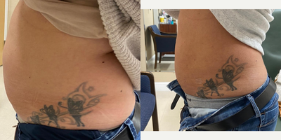 55-64 year old woman treated with truSculpt iD - Before and after 1 treatment of Trusculpt iD on the abdomen.