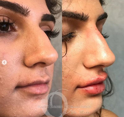 25-34 year old woman treated with Lip Augmentation - 25-34 year old woman treated with Lip Augmentation