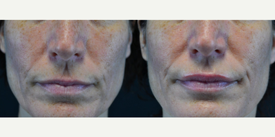 45-54 year old woman treated with Restylane - 46 year old female who received Restylane to the upper lip and Bellafill to nasolabial folds and marionette lines ; 2 weeks post-procedure.