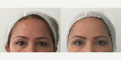Woman treated with Sofwave - Photo provided courtesy of Sofwave, performed by Dr. Annie Chiu.