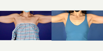 35-44 year old woman treated with BodyTite - PROCEDURE DETAILSBodyTite with Liposuction of ArmsPost-operative photo taken at 8 monthsPATIENT INFOSex: FemaleAge: 39