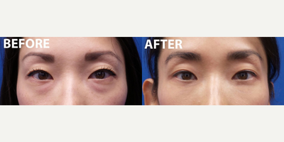 Woman treated with Kybella - Woman treated with Kybella