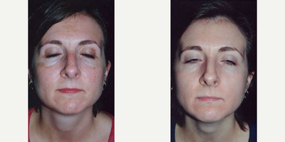 MegaPeel Microdermabrasion - MegaPeel Microdermabrasion