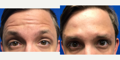 25-34 year old woman treated with Botox - Botox injection in the forehead and between the brows to reduce wrinkles.