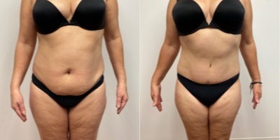 55-64 year old woman treated with Tummy Tuck - 14 months after an abdominoplasty muscle tightening and liposuction of hips