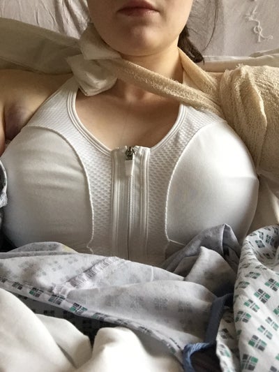 23 Year Old Scotland Breast Augmentation Aberdeen UK Review