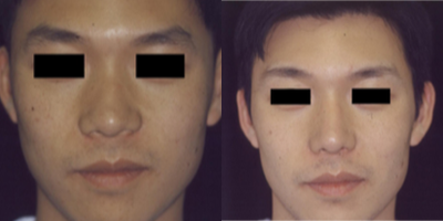 25-34 year old man treated with Asian Rhinoplasty - Individual results may vary.