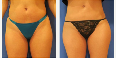 Woman treated with Butt Augmentation - Woman treated with Butt Augmentation using implants