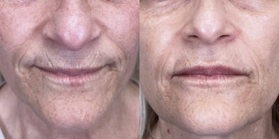 55 year old woman treated with Restylane Defyne - A 55-year-old female received dermal fillers, including 1 syringe of RHA and 1 syringe of Defyne, to improve lines and wrinkles around the mouth. The treatment provided a smoother, more youthful appearance, enhancing the natural contours of her lower face while maintaining a balanced and subtle look.