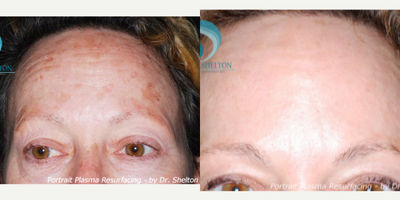55-64 year old woman treated with Fraxel Repair - Before and after results of Portrait Plasma Resurfacing