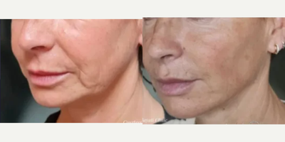Patient treated with Endolift - Patient treated with Endolift