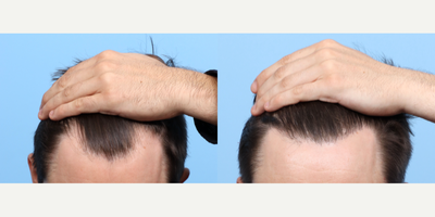 25-34 year old man treated with FUE Hair Transplant, Hair Transplant, Hair Loss Treatment, PRP for Hair Loss - Dr. Wise performed an FUE hair transplant on this patient, along with one treatment of PRP therapy. During the procedure, 2,274 grafts were transplanted to zone 1 to re-contour the hairline, with natural, face framing results.