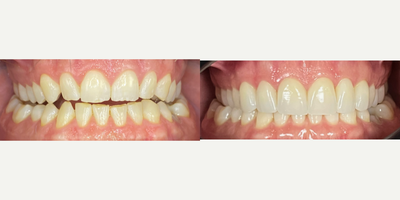 35-44 year old man treated with Porcelain Veneers, Lumineers, Invisalign - Patient was not aware of the amount of wear and he didn't know how important is to restore function on his teeth by repositioning into a better and more functional position. Patient had noticed a lot of wear during the past 5 years and he wanted to do something to stop this from getting worse. Once a comprehensive evaluation was completed, we sat down with him and showed him all the aspects of his smile that were not in the ideal parameters. Completing a full diagnosis of his bite and analyzing how he was functioning, we recommended to start his treatment plans sequence with orthodontic treatment with Invisalign, and once this phase was completed, we proceeded to restore the wear by fabricating minimally invasive porcelain veneers (Luminieers). Patient was happy to see his natural-looking teeth back, gave him a bust of confidence and he is able to smile better today!.