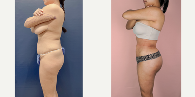 25-34 year old woman treated with Brazilian Butt Lift, Vaser Liposuction, Tumescent Liposuction - This lovely patient is shown 3 months post-op from 360 liposuction and Brazilian Butt Lift. This procedure combination allows for optimal shaping of the midsection while using the fat to improve the contour of the hips and buttocks. The result is a snatched waistline with a rounder and curvier lower half.
