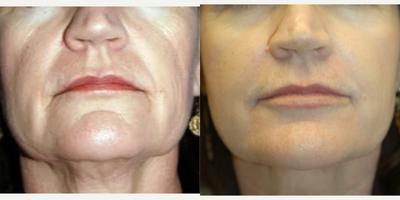 55-64 year old woman treated with Scar Removal, Laser Scar Removal - ProFractional and Thermage.