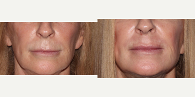 65-74 year old woman treated with Scar Removal, Laser Scar Removal - Patient did profractional laser resurfacing around the mouth