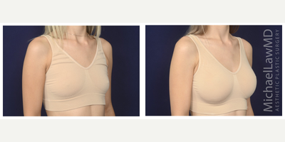 25-34 year old woman treated with Mentor Breast Implants - Breast augmentation. Follow-up photo taken 3 months after the procedure.