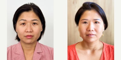 25-34 year old woman treated with Eyelid Surgery, Brow Lift, Canthoplasty - This patient had undergone double eyelid surgery approximately 10 years ago and presented with recurrent upper eyelid hooding caused by excess skin and fat. The inner corners of the eyes appeared partially covered, and mild brow descent further contributed to a tired appearance. A personalized treatment plan included upper blepharoplasty to address excess skin and fat, medial canthoplasty, and a sub-brow brow lift. The postoperative results show a more defined upper eyelid crease, a more open inner eye contour, improved brow position, and a naturally refreshed appearance while preserving the patient's unique facial features.
